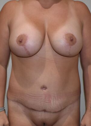 Mommy Makeover Case 254 - After