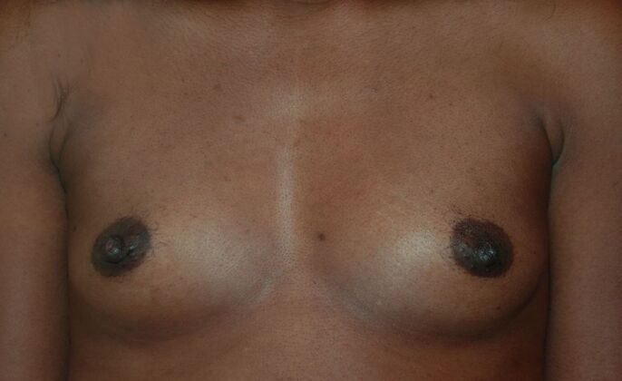 Breast Augmentation Case 732 - Before