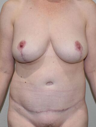 Mommy Makeover Case 268 - After