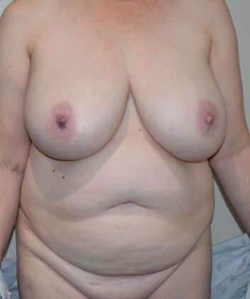 Mommy Makeover Case 268 - Before