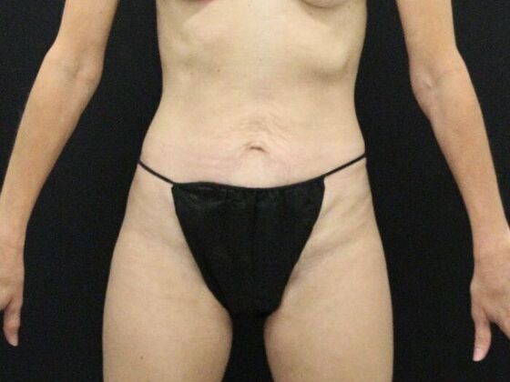 Tummy Tuck Case 46 - Before