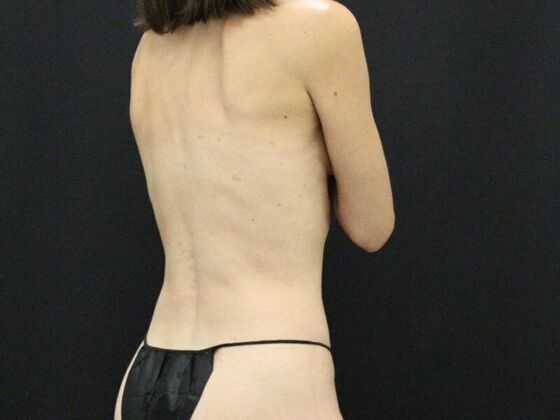 Tummy Tuck: Case 46 - Before