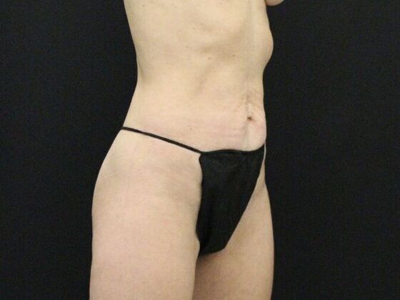 Tummy Tuck: Case 46 - Before