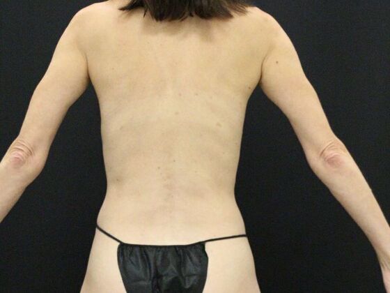 Tummy Tuck: Case 46 - Before