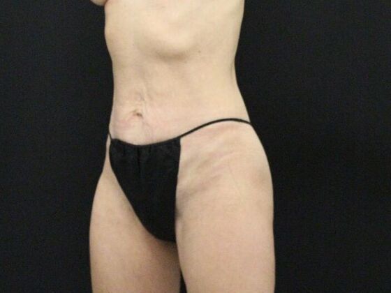 Tummy Tuck: Case 46 - Before