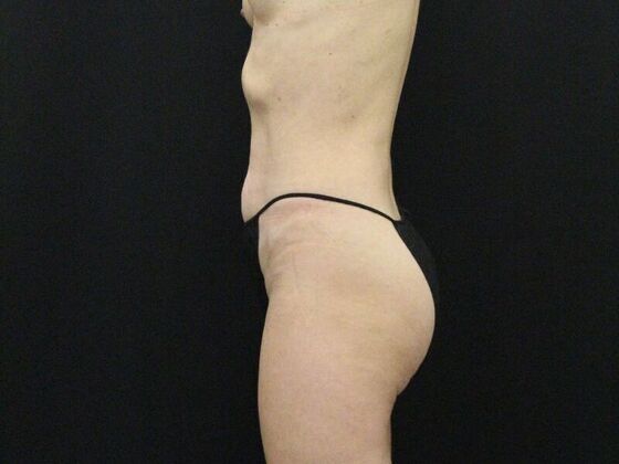 Tummy Tuck: Case 46 - Before