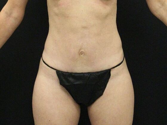 Tummy Tuck Case 46 - After