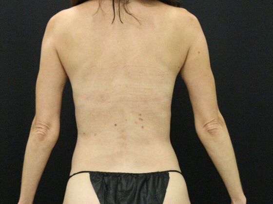 Tummy Tuck: Case 46 - After