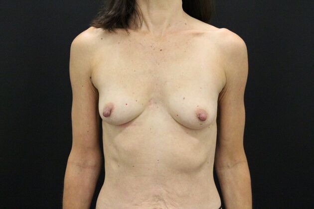 Breast Augmentation: Case 87 - Before