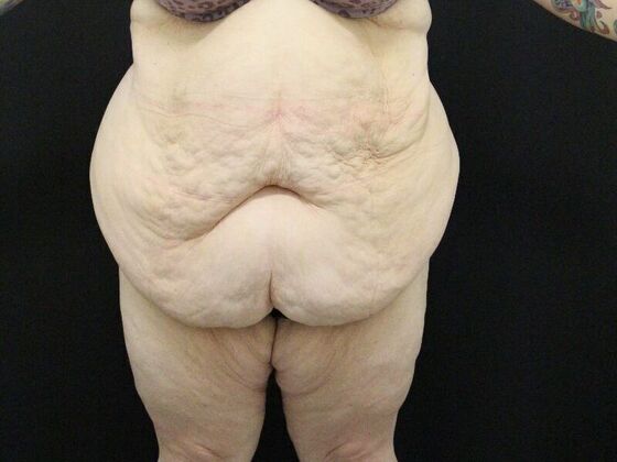 Tummy Tuck Case 47 - Before