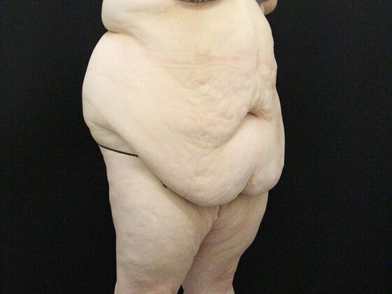 Tummy Tuck: Case 47 - Before