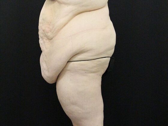 Tummy Tuck: Case 47 - Before