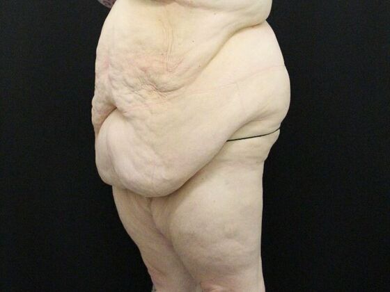 Tummy Tuck: Case 47 - Before