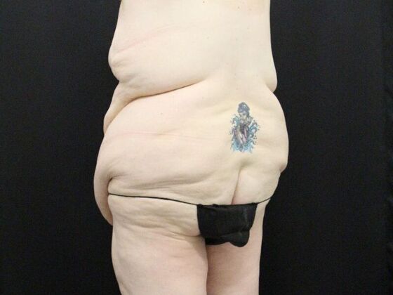 Tummy Tuck: Case 47 - Before