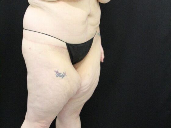 Tummy Tuck: Case 47 - After