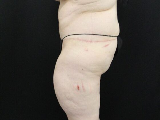 Tummy Tuck: Case 47 - After