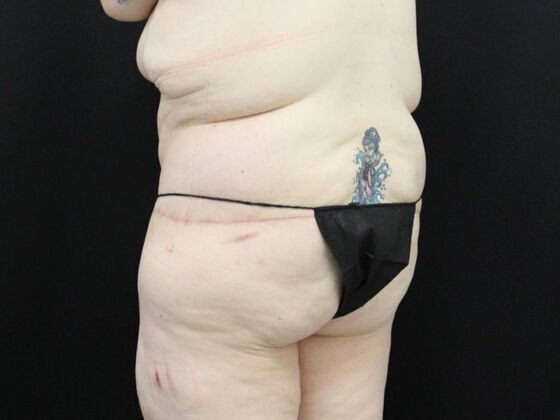 Tummy Tuck: Case 47 - After