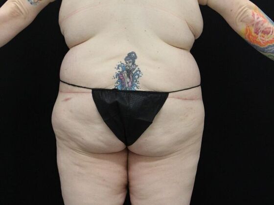 Tummy Tuck: Case 47 - After