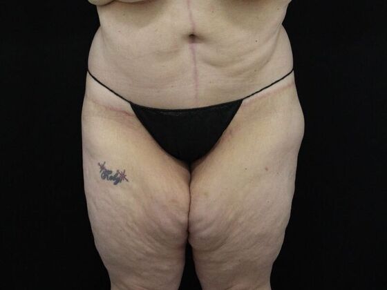 Tummy Tuck Case 47 - After