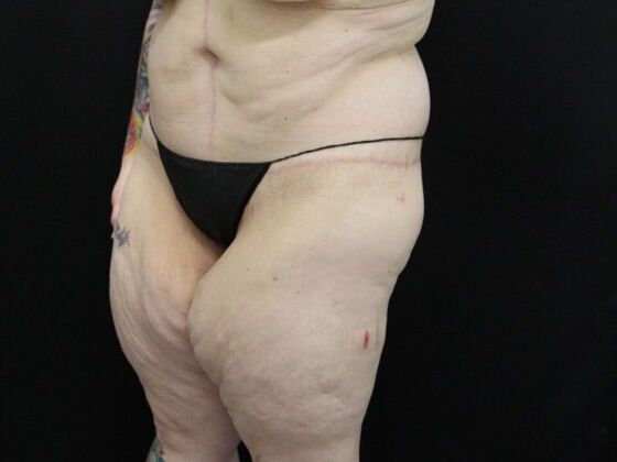 Tummy Tuck: Case 47 - After