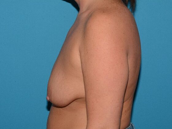 Breast Augmentation with Mastopexy: Case 8 - Carmel - Before