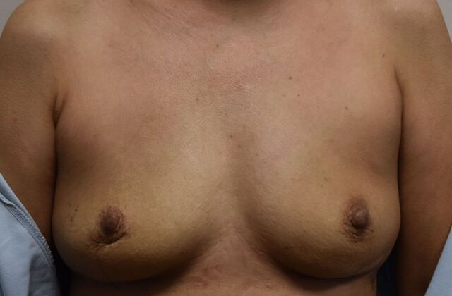 Breast Implant Removal: Case 28 - After