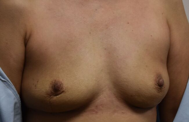 Breast Implant Removal: Case 28 - After