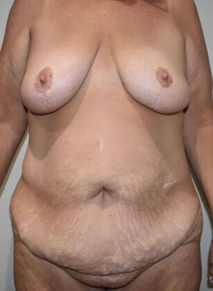 Massive Weight Loss : Case 131 - Before