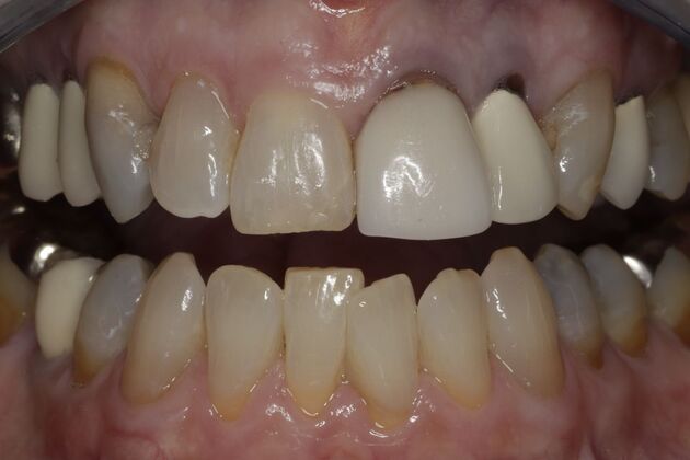 Cosmetic Dentistry Case 10 - Before
