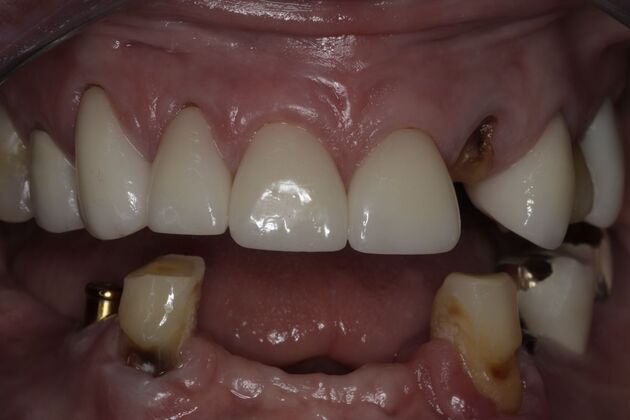Dental Implants: Case 8 - Before