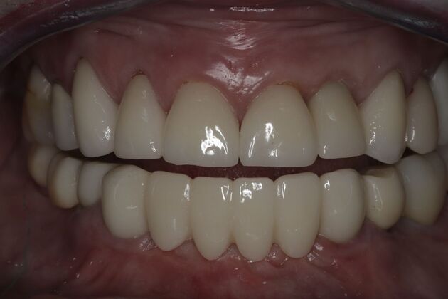 Dental Implants: Case 8 - After