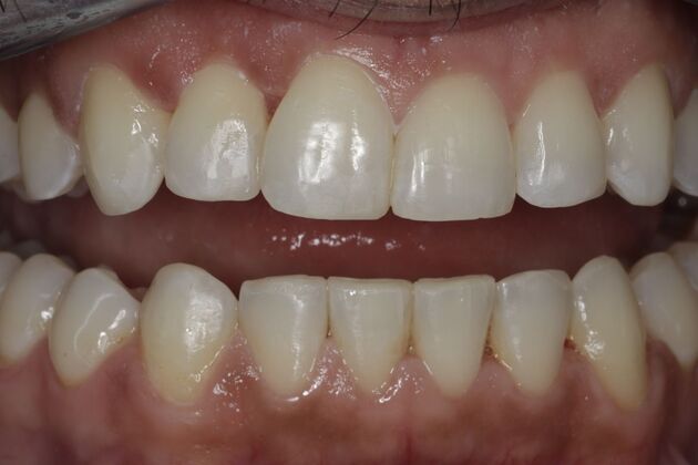 Invisalign Case 6 - After