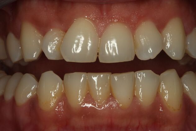 Invisalign Case 6 - Before