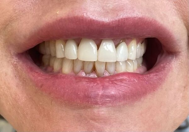 Smile Makeovers: Case 26 - Before