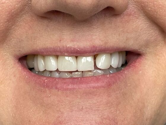 Porcelain Veneers: Case 36 - Before