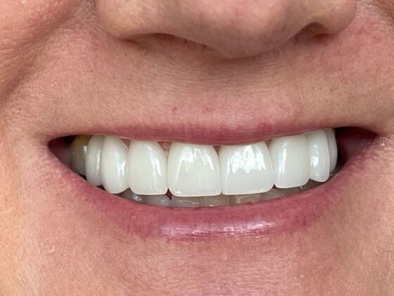 Porcelain Veneers: Case 36 - After