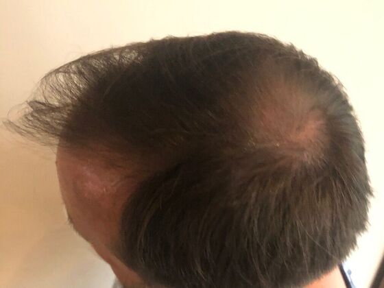 FUT Hair Restoration: Case 25 - Before