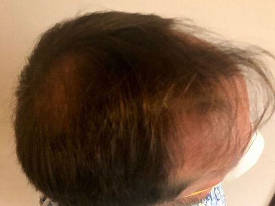 FUT Hair Restoration: Case 25 - Before