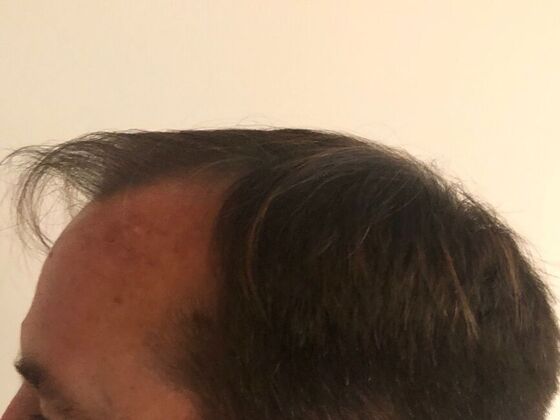 FUT Hair Restoration: Case 25 - Before