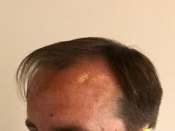 FUT Hair Restoration: Case 25 - Before