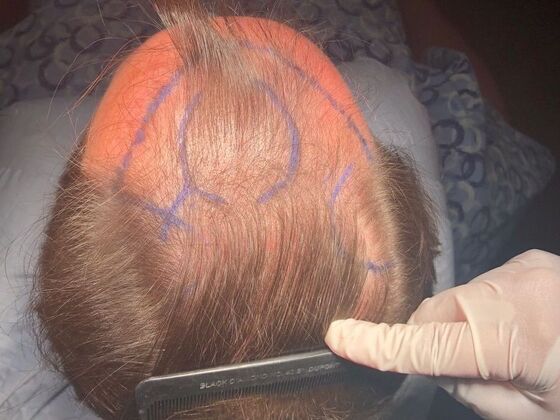 FUT Hair Restoration: Case 25 - Before