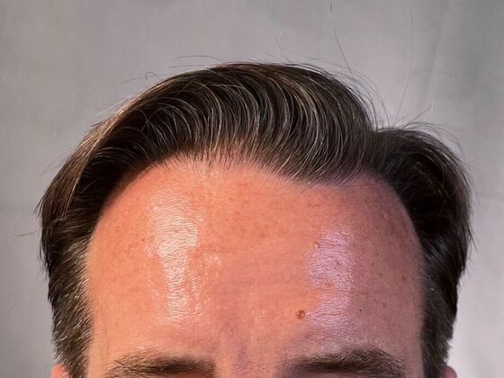 FUT Hair Restoration Case 25 - After