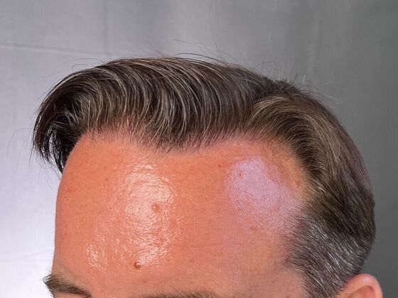 FUT Hair Restoration: Case 25 - After