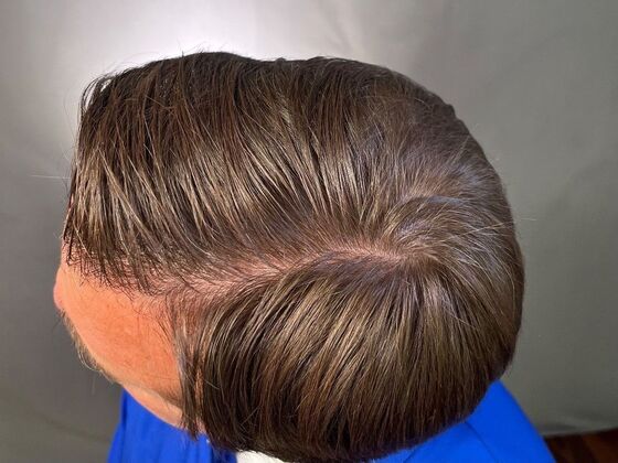 FUT Hair Restoration: Case 25 - After