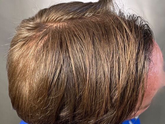 FUT Hair Restoration: Case 25 - After