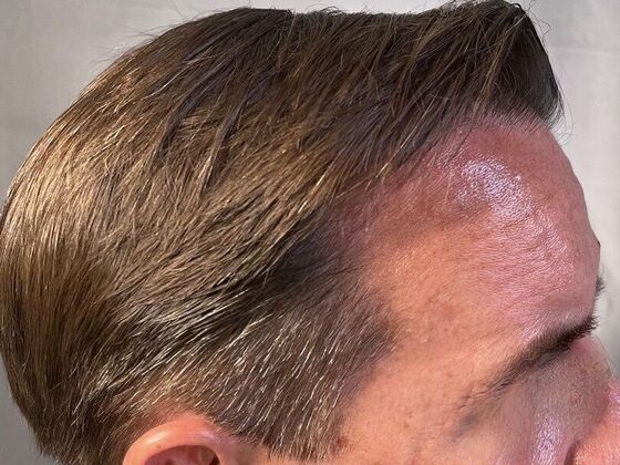 FUT Hair Restoration: Case 25 - After