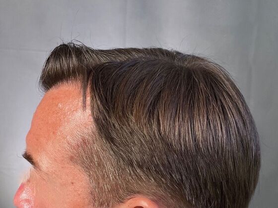 FUT Hair Restoration: Case 25 - After