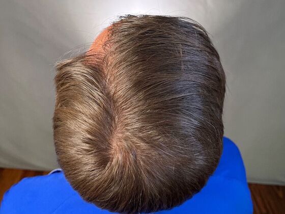 FUT Hair Restoration: Case 25 - After