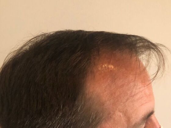 FUT Hair Restoration: Case 25 - Before