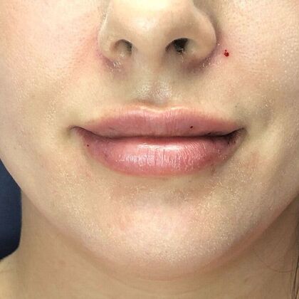 Cosmetic Injectables & Fillers*: Case 47 Lip Filler - After